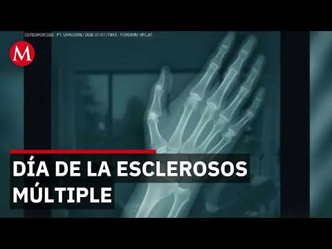 Día mundial de la esclerosos múltiple: Antonieta Sea thumbnail