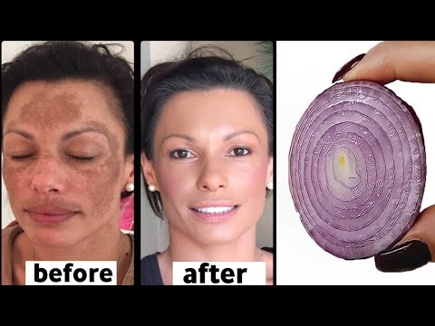 Mix onion with cornstarch  to get firm skin, without wrinkles or fine lines thumbnail