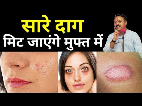 चेहरे के सारे दाग मिट जाएंगे मुफ्त में || चेहरे के दाग धब्बे कील मुहांसों जले हुए के निशान करें साफ thumbnail