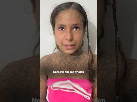 “Necesito ayuda para mi piel”. Angélica no pide juguetes ni regalos... pide ayuda para ir al médico thumbnail