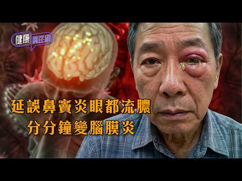 延誤鼻竇炎眼都流膿 分分鐘變腦膜炎 ｜ 健康關注組 ｜ EP575 ｜ 鼻竇炎 ｜ 腦膜炎 ｜ 洗鼻 ｜ 吳雲甫 ｜ 朱智賢 ｜ HOY thumbnail