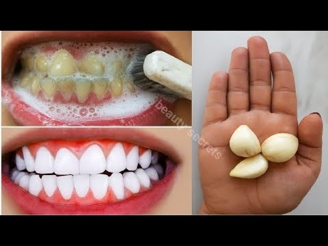 The secret that dentists don't want you to know: Removes tartar and whitens teeth in 1 minute. thumbnail