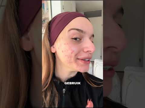Ik hoop dat je weet dat je niet de enige bent en dat je prachtig bent ook met acne❤️ #mentalhealth thumbnail