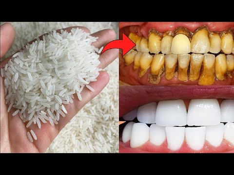 The recipe that dentists are hiding from us🔥!It whitens teeth and eliminates tartar in 1 minutes. thumbnail