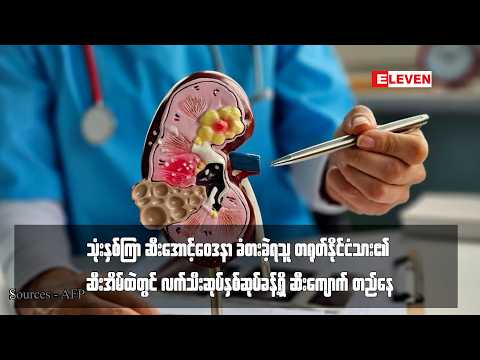 တရုတ်နိုင်ငံသား၏ ဆီးအိမ်ထဲတွင် လက်သီးဆုပ်နှစ်ဆုပ်ခန့်ရှိ ဆီးကျောက်တည်နေ thumbnail