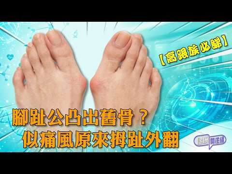 【高跟族必睇】腳趾公凸出舊骨？似痛風原來拇趾外翻 ｜ 健康關注組 ｜ EP568 ｜ 拇趾外翻 ｜ 高踭鞋 ｜ 痛風 ｜ 扁平足 ｜ 敖嘉年 ｜ 麥詩敏 ｜ HOY thumbnail