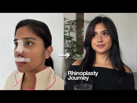 My Rhinoplasty Journey thumbnail