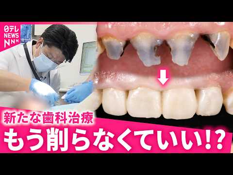【スゴい！】常識を変える歯科治療！歯を"削らずに"治す最新技術 開発者の思い　徳島　NNNセレクション thumbnail