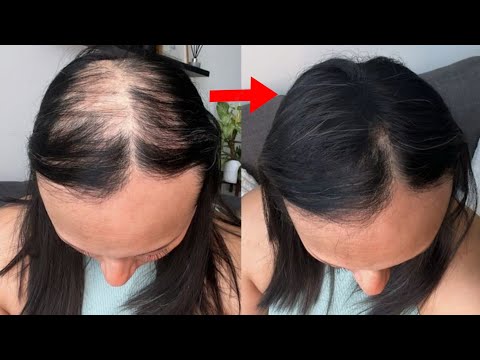 Spray it on your hair for just 2 days and it will grow like crazy and never fall out. thumbnail