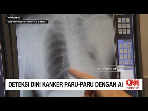 Deteksi Dini Kanker Paru Paru dengan AI thumbnail