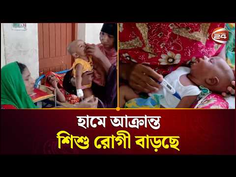 হামে আক্রান্ত শিশু রোগী বাড়ছে | Measles Outbreak | Health Alert | Channel 24 thumbnail