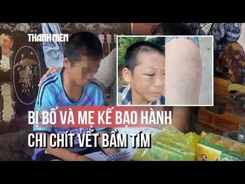 Toàn cảnh vụ bé trai nghi bị bố và mẹ kế bạo hành: Đã nhập viện với chi chít vết bầm tím thumbnail