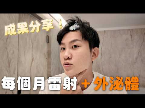真實體驗每個月都做雷射+外泌體！什麼是外泌體？【Joeman】 thumbnail