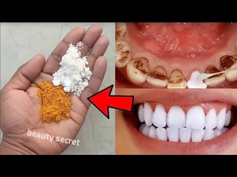 The recipe that dentists are hiding from us🔥!It whitens teeth and eliminates tartar in 1 minutes thumbnail