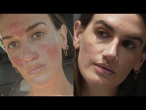 Woman Says She Suffered Severe Burns After Facial From Celebrity Esthetician thumbnail