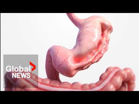 New, non-surgical weight loss procedure now available at Alberta hospital thumbnail