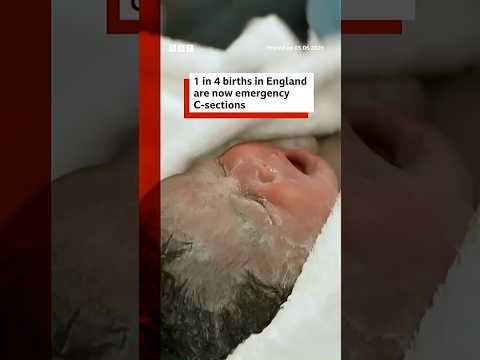 One in four births in England are now emergency caesareans, BBC analysis shows. #BBCNews thumbnail